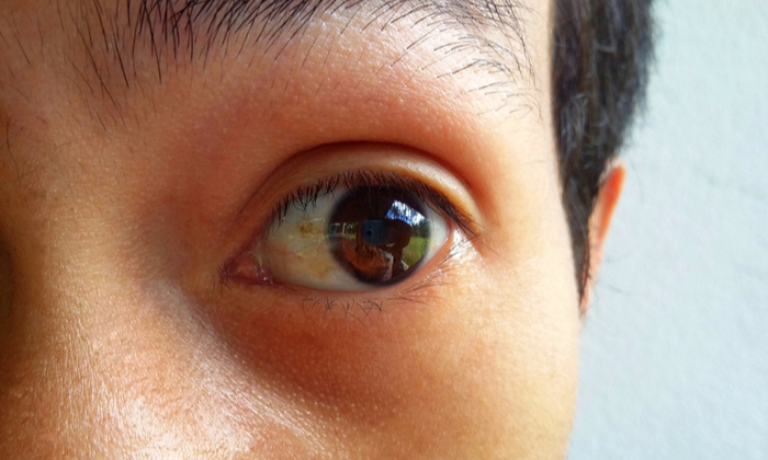 ต้อลม (Pinguecula) ปัญหาดวงตาใกล้ตัว อย่ามัวแต่ละเลย