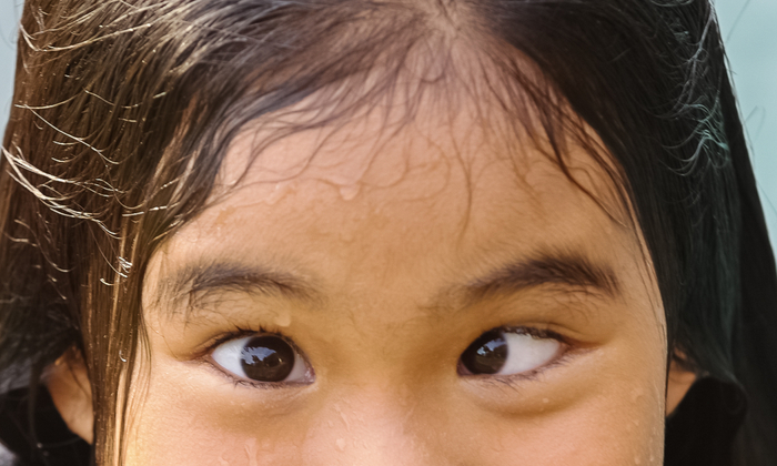 ตาเข (Strabismus)