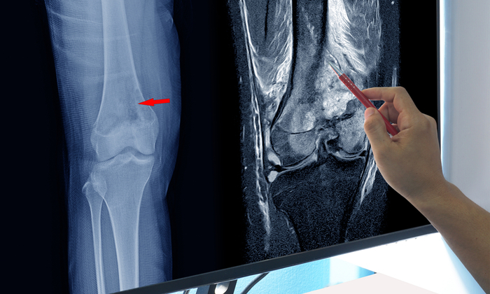 เนื้องอกข้อต่อ หนึ่งในโรคหายาก ที่ทุกคนไม่ควรมองข้าม