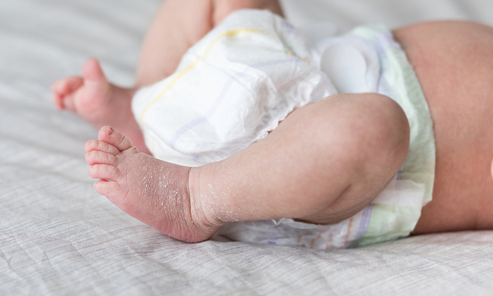 ทารกผิวลอก กับวิธีจัดการอย่างง่ายๆ สำหรับพ่อแม่มือใหม่