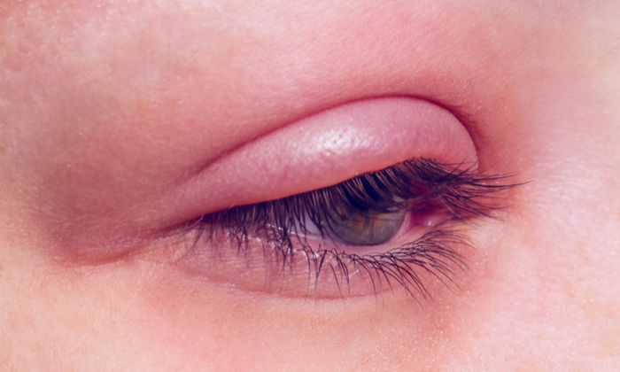 เปลือกตาอักเสบ (Blepharitis)