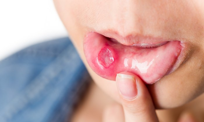 ปากเปื่อยร้อนใน มีสาเหตุจากโรคไข้หวัดจริงหรือ