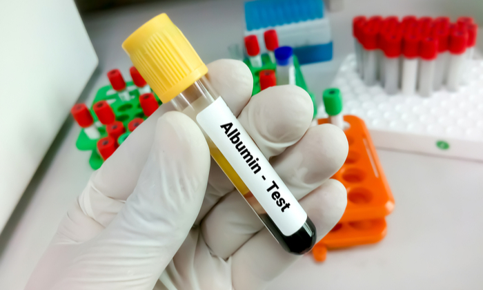 ภาวะไมโครอัลบูมินนูเรียในปัสสาวะผู้ป่วยเบาหวานชนิดที่ 2