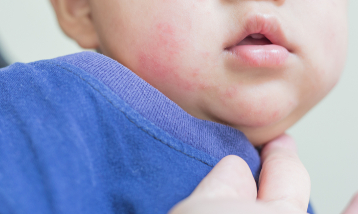 ลูกเป็นผื่นที่หน้า ปัญหาผิวหนังในเด็ก ที่พ่อแม่ควรใส่ใจ