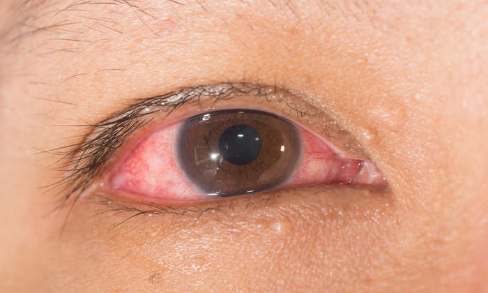 ตาขาวอักเสบ จนตาแดง และเจ็บปวด ควรรักษาอย่างไร