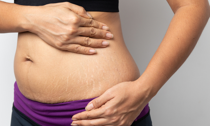 หน้าท้องแตกลายหลังคลอด รับมืออย่างไร ให้รอยจางลง