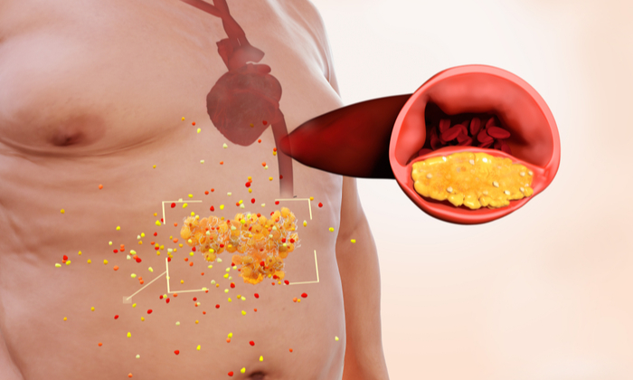 ป้องกันโรคหลอดเลือดแดงแข็ง ด้วยการดูแลสุขภาพอย่างถูกวิธี