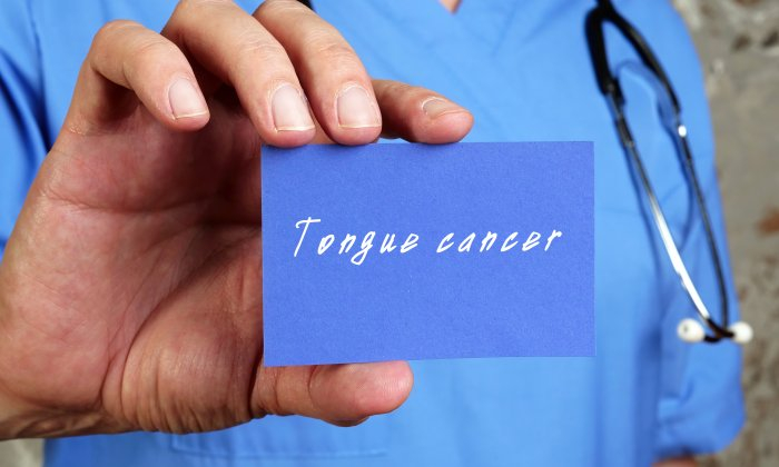 มะเร็งโคนลิ้น (Base of Tongue Cancer)