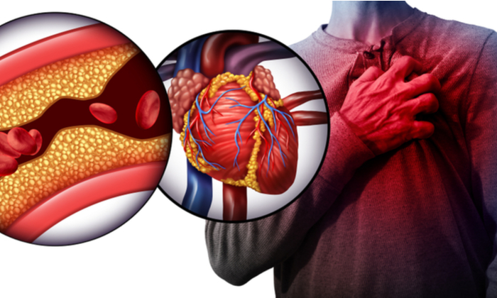 7 ปัจจัยเสี่ยงของโรคหลอดเลือดหัวใจ ที่คุณไม่ควรมองข้าม