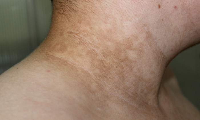 5 วิธีดูแลผิวผู้ป่วยเบาหวาน