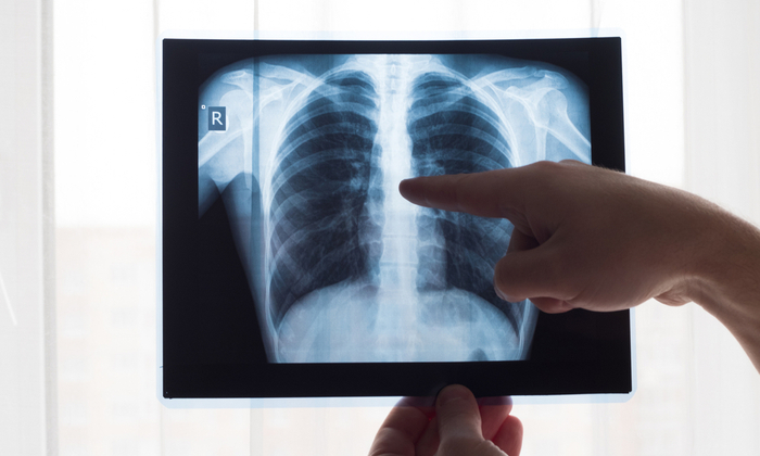 ทำความรู้จักกับ วัณโรคแฝง ภัยร้ายที่มักไม่แสดงอาการ