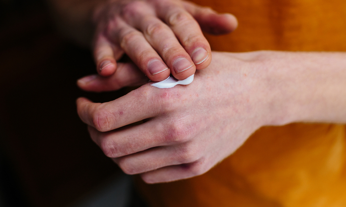 วิธีป้องกันโรคสะเก็ดเงิน และสัญญาณโรคสะเก็ดเงินที่ควรรู้