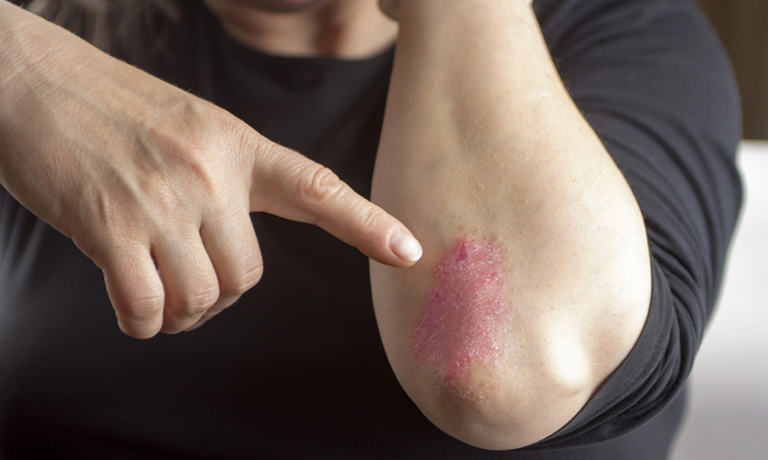 ปัจจัยกระตุ้นอาการโรคสะเก็ดเงิน มีอะไรบ้าง