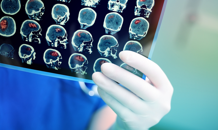 ใครอยากรู้บ้างว่า วิธีรักษาเนื้องอกในสมอง มีกี่วิธี