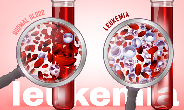 มะเร็งเม็ดเลือดขาวชนิดเฉียบพลัน มีกี่ชนิดกันนะ แล้วชนิดไหนรุนแรงกว่ากัน