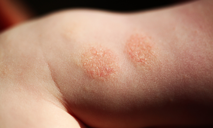 ผื่นผิวหนังอักเสบรูปเหรียญ คืออะไร และจะรักษาได้อย่างไร