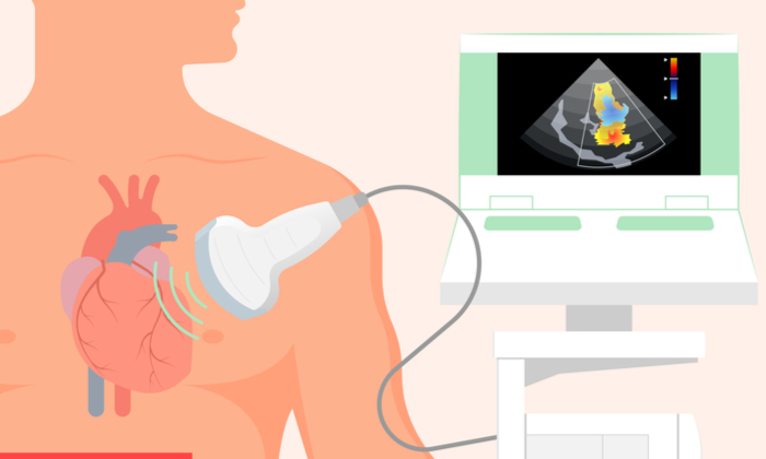 เช็กสุขภาพหัวใจ ด้วย การตรวจหัวใจด้วยคลื่นเสียงความถี่สูง