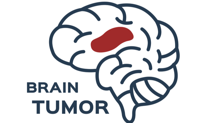 เนื้องอกในสมองที่พบบ่อย แต่ใครหลายคนอาจไม่เคยรู้