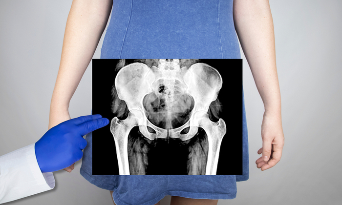 กระดูกเชิงกรานหัก ส่วนใหญ่เกิดจากสาเหตุใดกันนะ