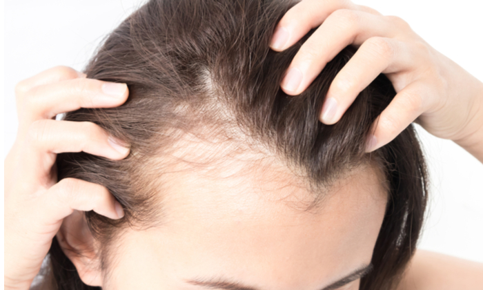 ปัญหาหนังศีรษะและเส้นผม เรื่องใกล้ตัว ที่ไม่ควรมองข้าม