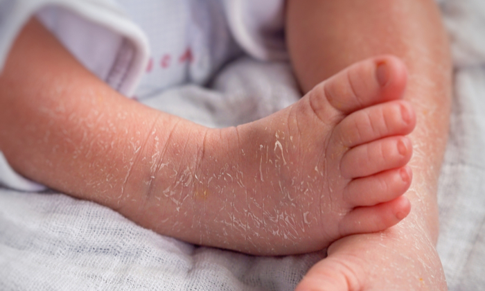 ดูแลทารกผิวแห้ง ทำได้อย่างไร  เพื่อให้ผิวลูกชุ่มชื้น