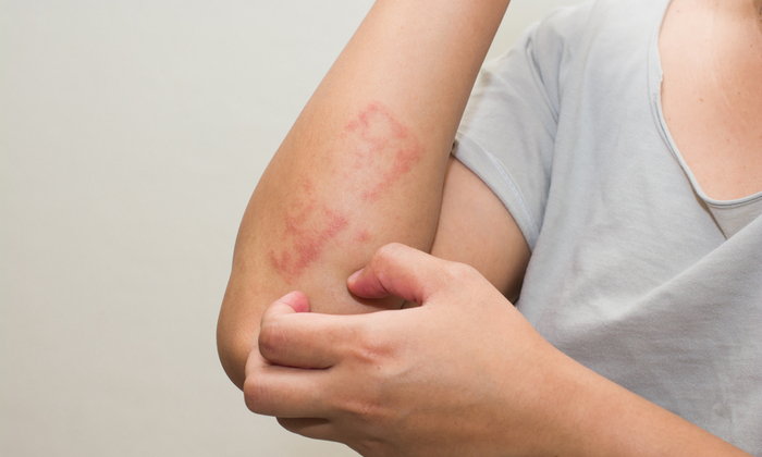 โรคผิวหนังในหน้าฝน ที่ควรระวัง มีอะไรบ้าง