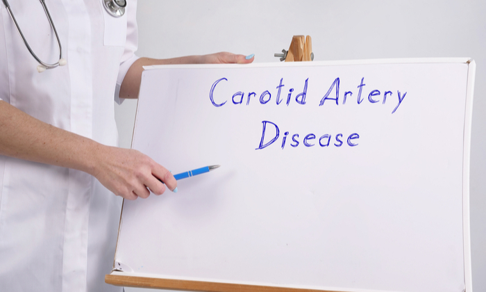 หลอดเลือดแดงคาโรติดตีบตัน (Carotid Artery) กับความรู้พื้นฐานของโรค ที่คุณควรทราบ