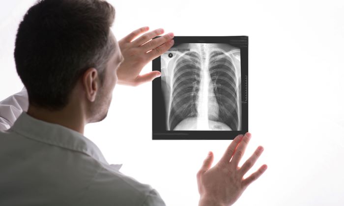 สาเหตุของโรคปอดบวม ที่อาจก่อให้เกิดภาวะแทรกซ้อน มีอะไรบ้าง