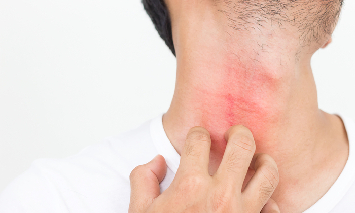 ภาวะเดอร์มาโทกราเฟีย อาการและการป้องกัน