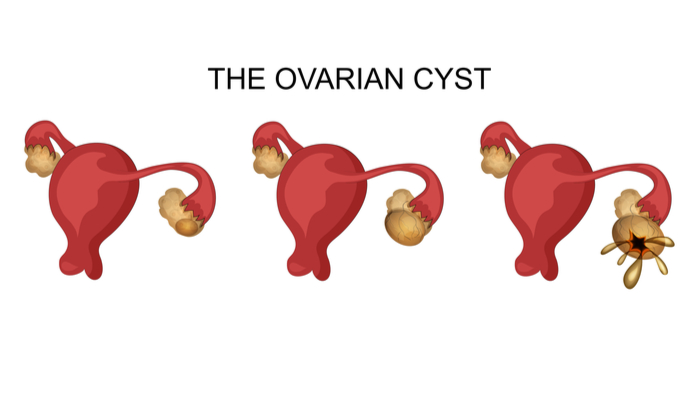 ถุงน้ำในรังไข่แตก คืออะไร อันตรายหรือไม่อย่างไร