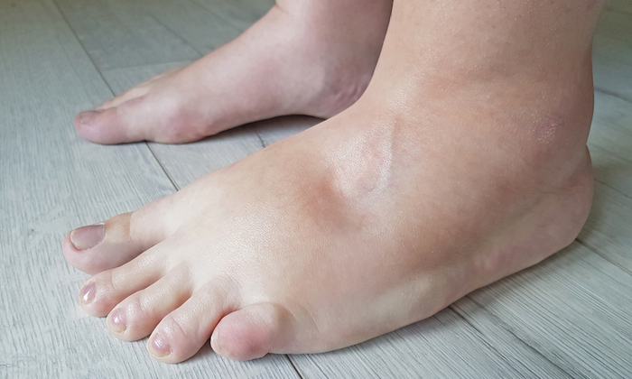 อาการบวมส่วนปลายในผู้ป่วยเบาหวาน สาเหตุ และการรับมือ