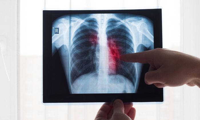 ปัจจัยเสี่ยงของโรคลิ่มเลือดอุดกั้นในปอด ที่ควรรู้ เพื่อรับมือในการป้องกัน