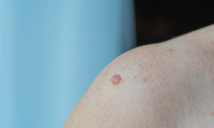 ปัจจัยเสี่ยงของติ่งเนื้อบนผิวหนัง และวิธีรักษาติ่งเนื้อ