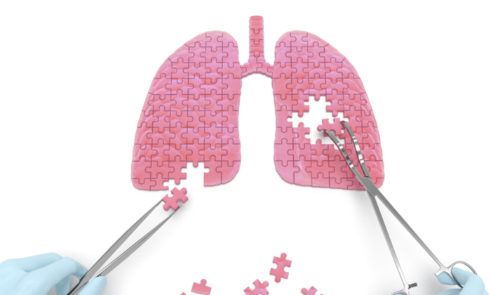 การรักษาโรคลิ่มเลือดอุดกั้นในปอด ฟื้นฟูสุขภาพปอด ด้วยเทคนิคทางการแพทย์