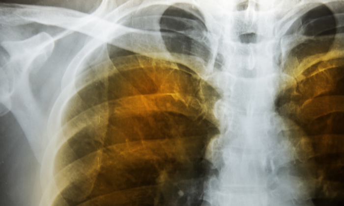 โรคถุงลมโป่งพองระยะที่ 4 ระยะอันตราย ที่ผู้ป่วยควรระวัง