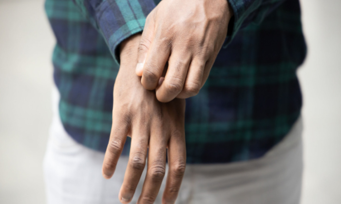 โรคสะเก็ดเงินชนิดผื่นหนา (Plaque psoriasis)