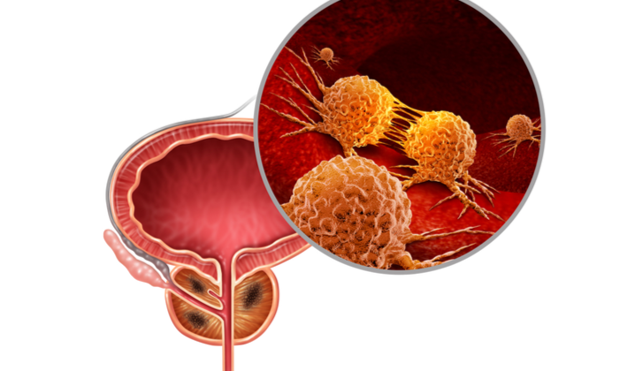 มะเร็งต่อมลูกหมากระยะแรก ที่คุณผู้ชายควรรู้