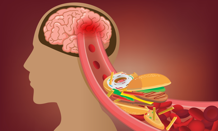 คอเลสเตอรอลสูง ทำให้คุณเสี่ยงเป็น โรคหลอดเลือดสมอง ได้จริงหรือ?