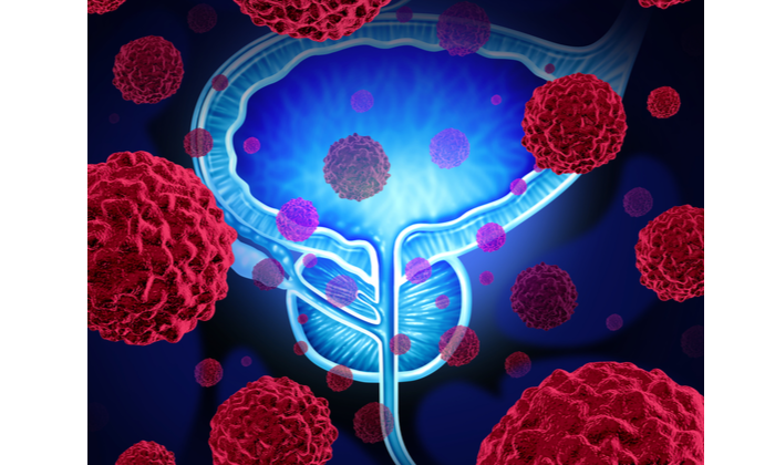 มะเร็งต่อมลูกหมากระยะสุดท้าย พร้อมวิธีการดูแลผู้ป่วย