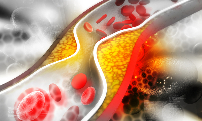 อาการของโรคหลอดเลือดแข็ง ระดับรุนแรง ที่คุณต้องเข้าพบคุณหมอโดยด่วน!