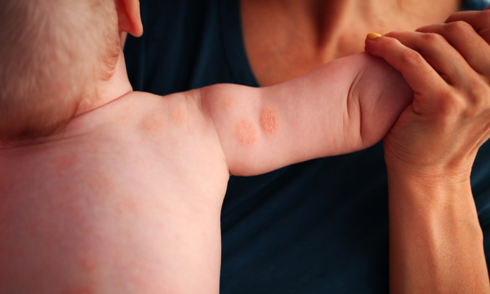 ผื่นรูปเหรียญ อาการ สาเหตุ และการรักษา