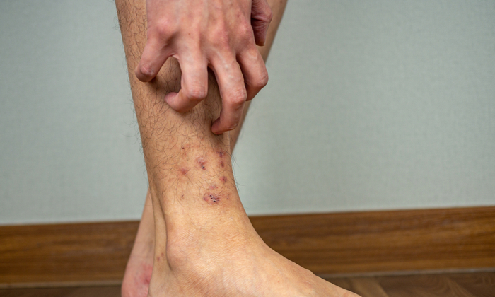 ผื่นผิวหนังอักเสบที่ข้อเท้า อาการ สาเหตุ วิธีรักษาและป้องกัน