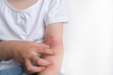 โรคผื่นภูมิแพ้ผิวหนังในเด็ก รู้ทัน ป้องกันก่อนสายเกินไป