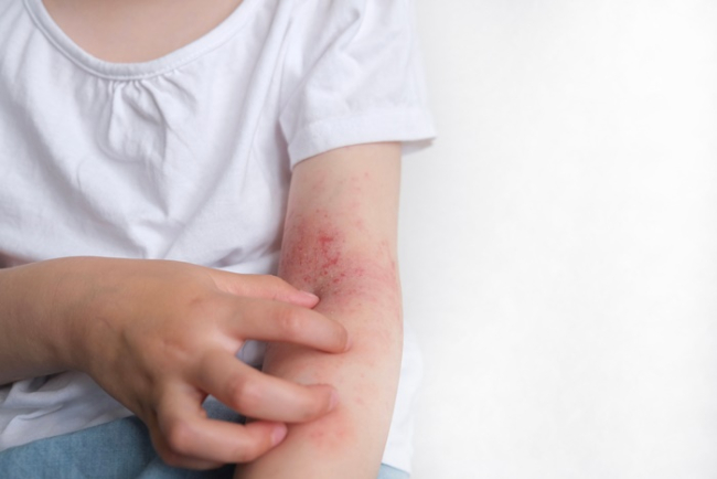 โรคผื่นภูมิแพ้ผิวหนังในเด็ก รู้ทัน ป้องกันก่อนสายเกินไป