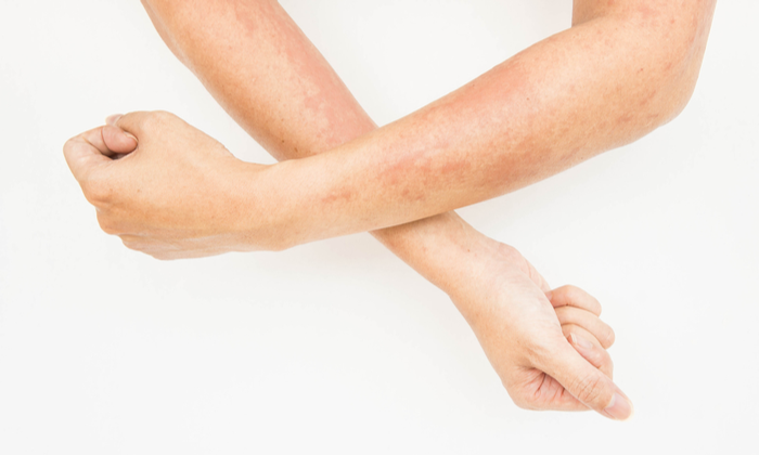 การติดเชื้อราที่ผิวหนัง ปัญหาผิวใกล้ตัว