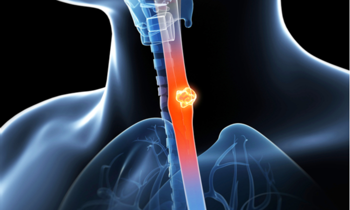 มะเร็งหลอดอาหาร