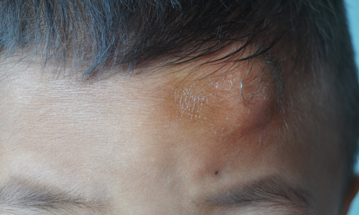 หัวโน อาการ สาเหตุ และวิธีการรักษา