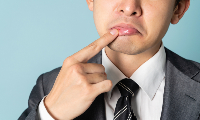 เชื้อราในปาก