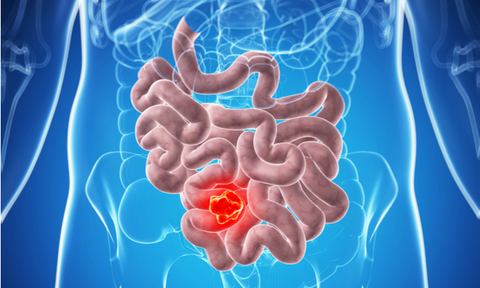 มะเร็งลำไส้เล็ก