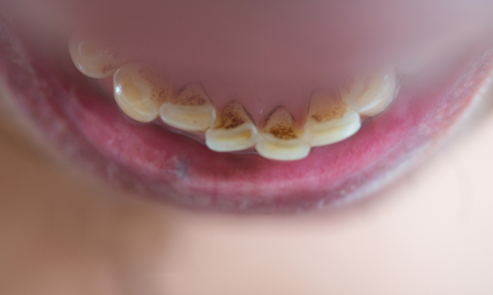 คราบหินปูน อาการ สาเหตุ การรักษา